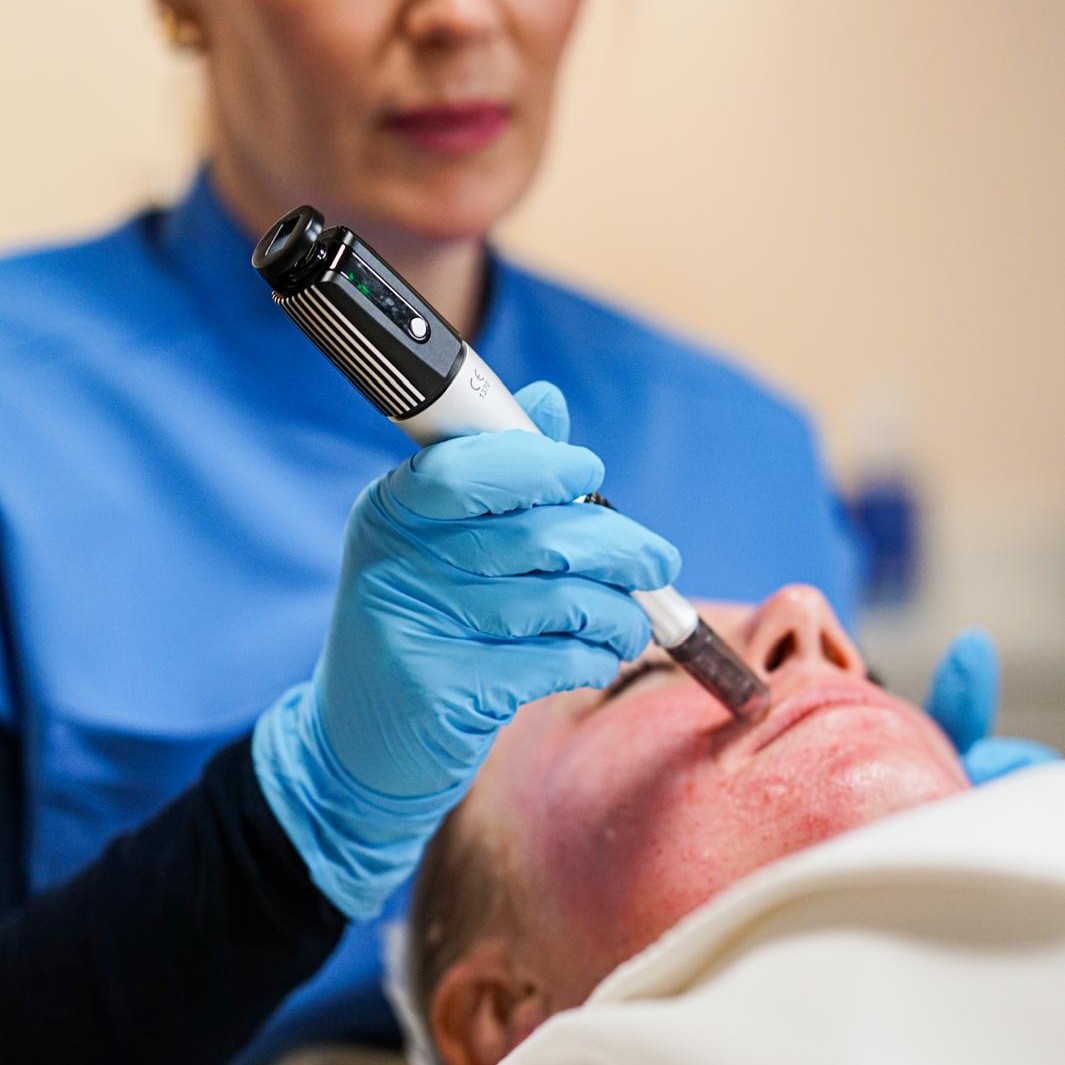 Microneedling is a minimally invasive procedure for your skin encompassing a medical grade targeted serum. Using a device that has thin needles to make tiny holes in the top layer of your skin. The damage helps stimulate your skin's healing process, producing more collagen and elastin.